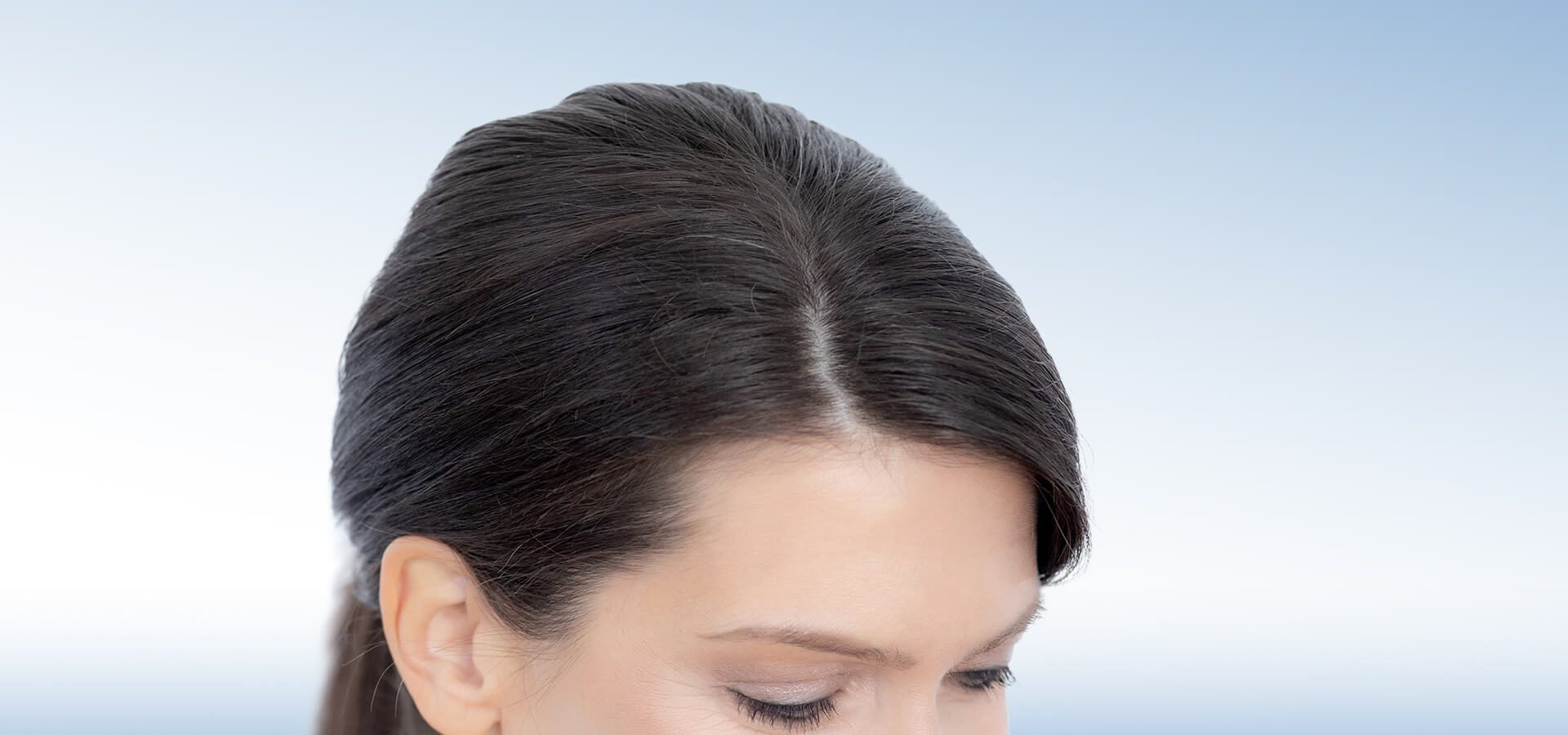 Androgenetische Alopezie, Haartransplantation, männlicher Oberkopf